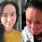 Woman overcomes agonising eczema that blinded her: ‘Today, I am a normal person’