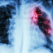 Tuberculosis deaths rising again in Europe - WHO