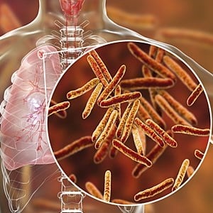 TB is caused by Myobacterium Tuberculosis and is a leading cause of death.