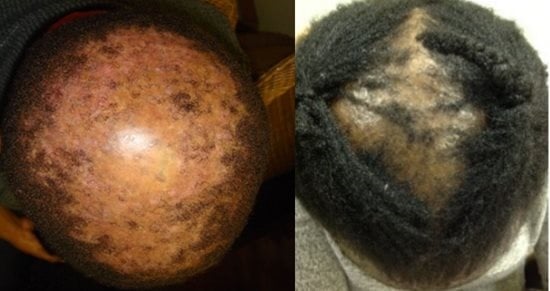 CCCA alopecia hair loss