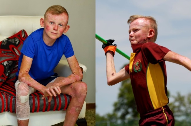 Hannes Taljaard tackles every­thing with zeal despite his skin condition. He recently participated in javelin throwing at his school. (PHOTO: Lubabalo Lesolle)