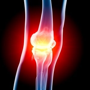 Exercise is good for arthritis of the knee. 