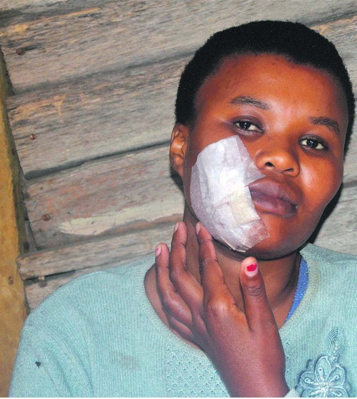 Zikhona Ntshebe claims her cheek was hit when cops fired rubber bullets at residents.                             Photo by Lulekwa Mbadamane