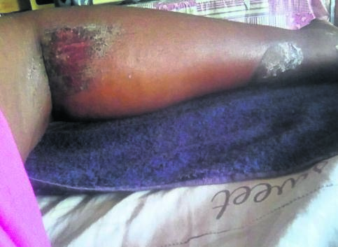 Thobisile Ngema was left with injuries to her legs after being hit by an ambulance. 