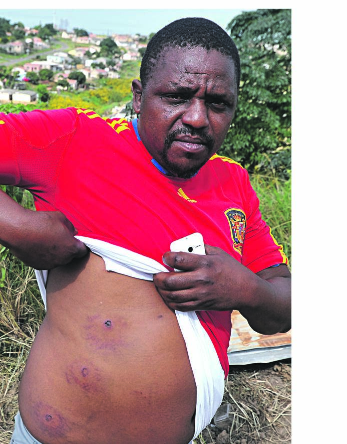 Vuyani Mzotho shows injuries he allegedly sustained when municipal guards demolished shacks at Ntuzuma, north of Durban. 
