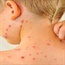 Could the chickenpox vaccine shield kids from shingles too?