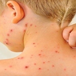 People who had chicken pox as children may develop shingles later in life. 