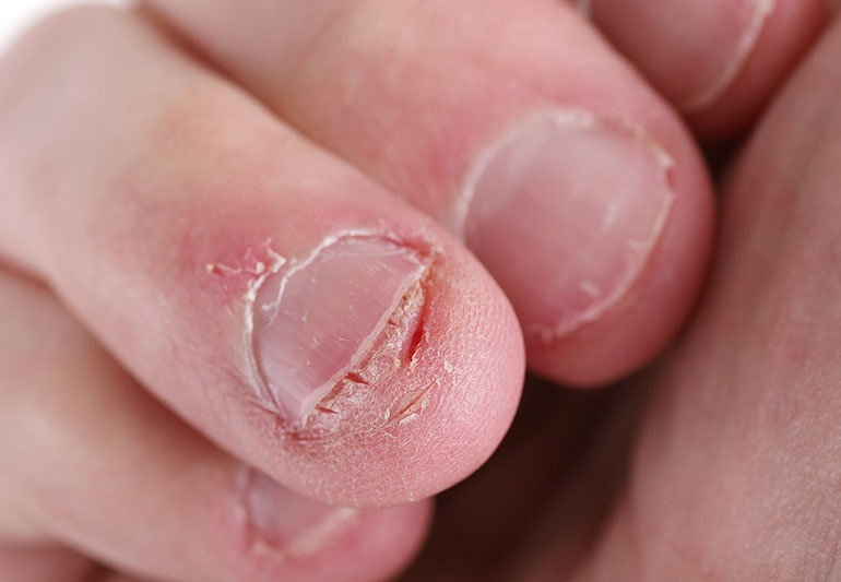 THE HEALTH RISKS OF BITING YOUR NAILS!