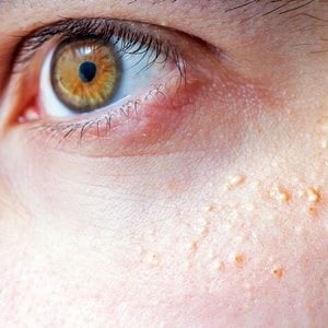 What are those little milky bumps on your face and how do you get rid of them?