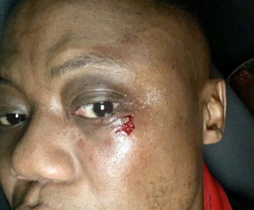 DJ Tira was injured underneath his eye by a beer bottle thrown to him while on stage playing at University of Venda on Saturday morning.