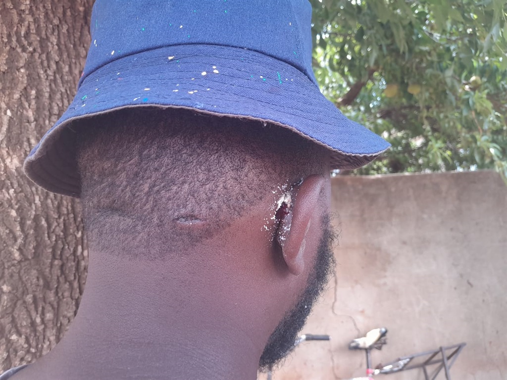 A shooting survivor was allegedly shot in the ear at Greenfields, Ekurhuleni. Photo by Happy Mnguni
