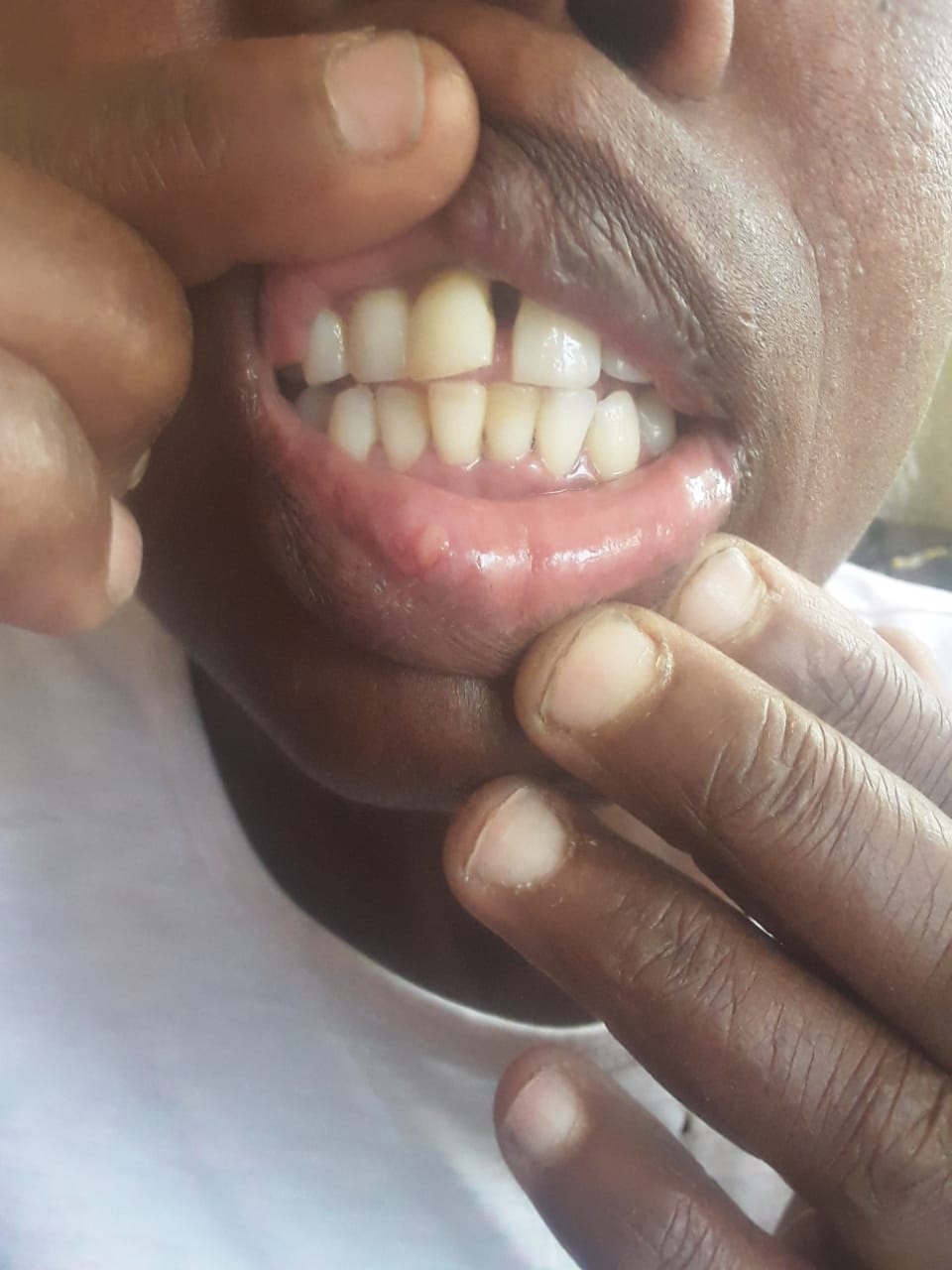 The woman claims she was klapped and her teeth are loose as a result. Photo by Ntebatse Masipa