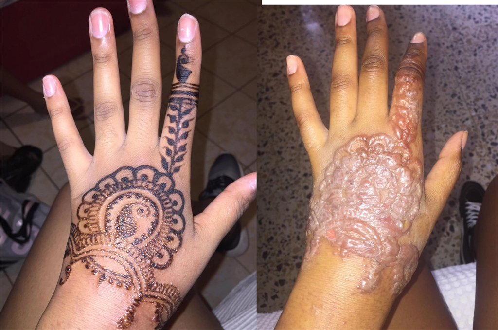 DOES HENNA REALLY CAUSE SCARRING? | Daily Sun