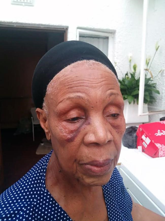 Veteran actress and singer Abigail Kubeka’s face is black and blue after being assaulted by a taxi driver. Photo from Facebook