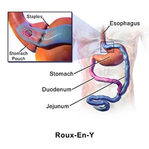 Illustration of Roux-en-Y gastric bypass surgery. Source: Blausen.com staff. "Blausen gallery 2014". Wikiversity Journal of Medicine. DOI:10.15347/wjm/2014.010