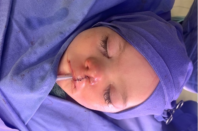 Hanru is pictured undergoing a series of procedures to correct a cleft lip condition.