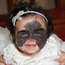 Baby with a ‘batman birthmark’ on face undergoes surgery