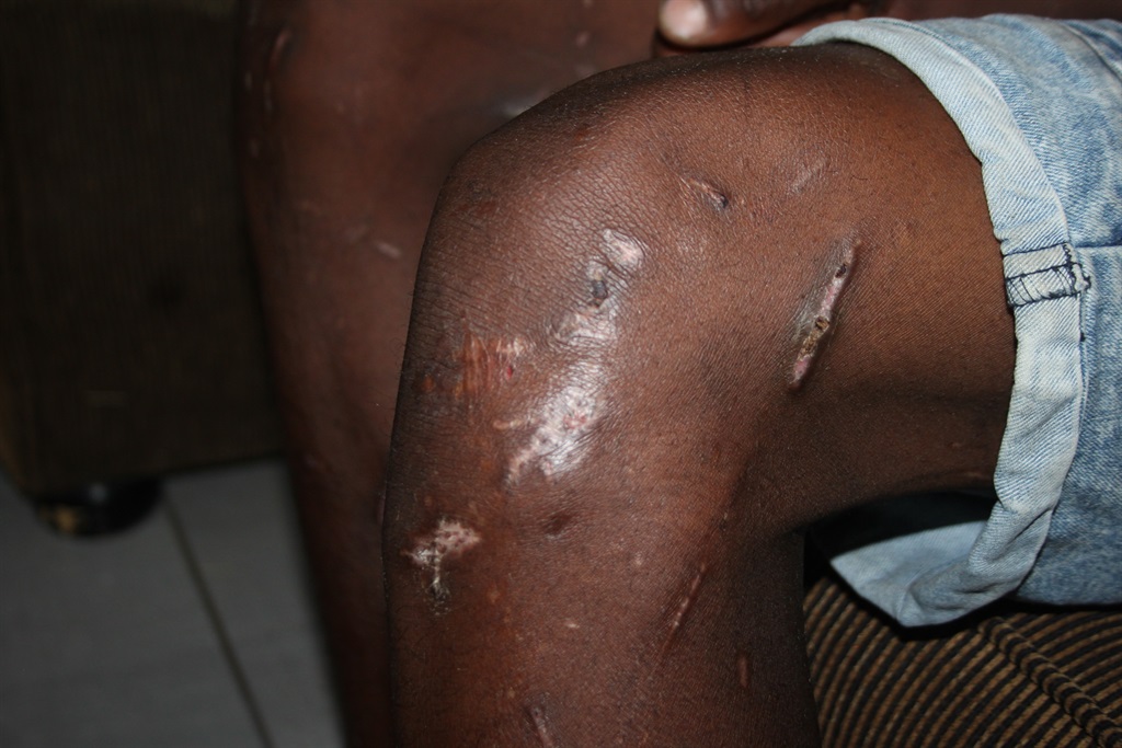 Lesedi Mbanguzi's friend shows cuts on his legs. Photo by Phineas Khoza