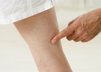 Varicose veins: Are they harmful?
