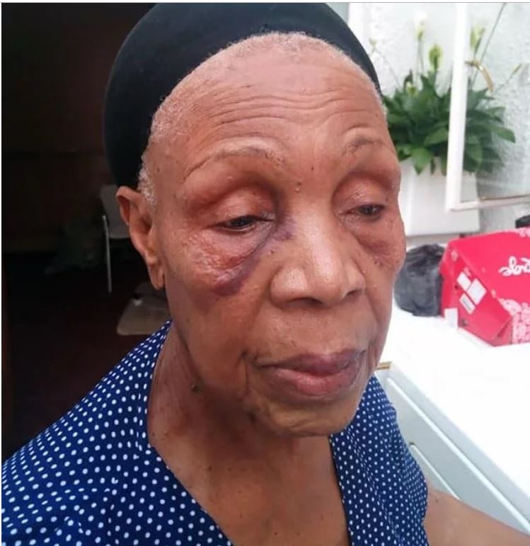 Veteran actress and singer Abigail Kubeka’s face is black and blue after being assaulted by a taxi driver. Photo from Facebook.