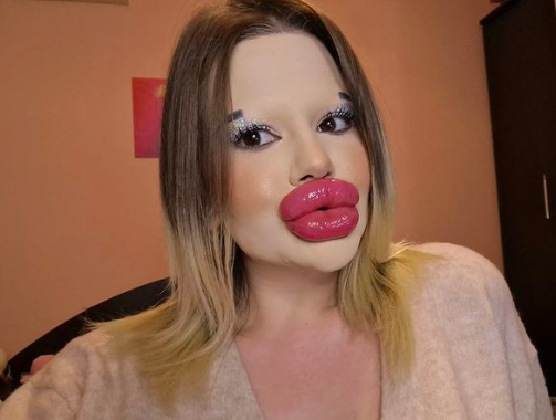 After 43 lip procedures, 25-year-old says 'extravagant appearance' hinders  her love life | Life
