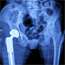 X-rays may miss hip arthritis