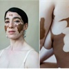 PICS: Photographer creates series to celebrate women with vitiligo