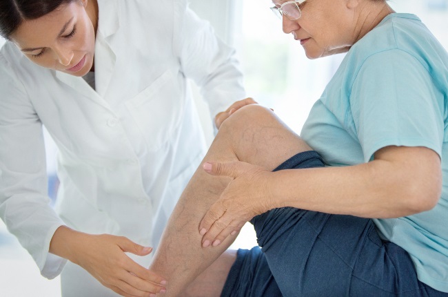 Varicose veins can become more common as you age, but they can occur when you're younger depending on your genes. (PHOTO: Gallo Images / Getty Images)