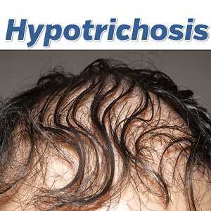 Hypotrichosis in a male. Source: Endhairloss.eu