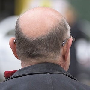 Balding man. Source: Pixabay