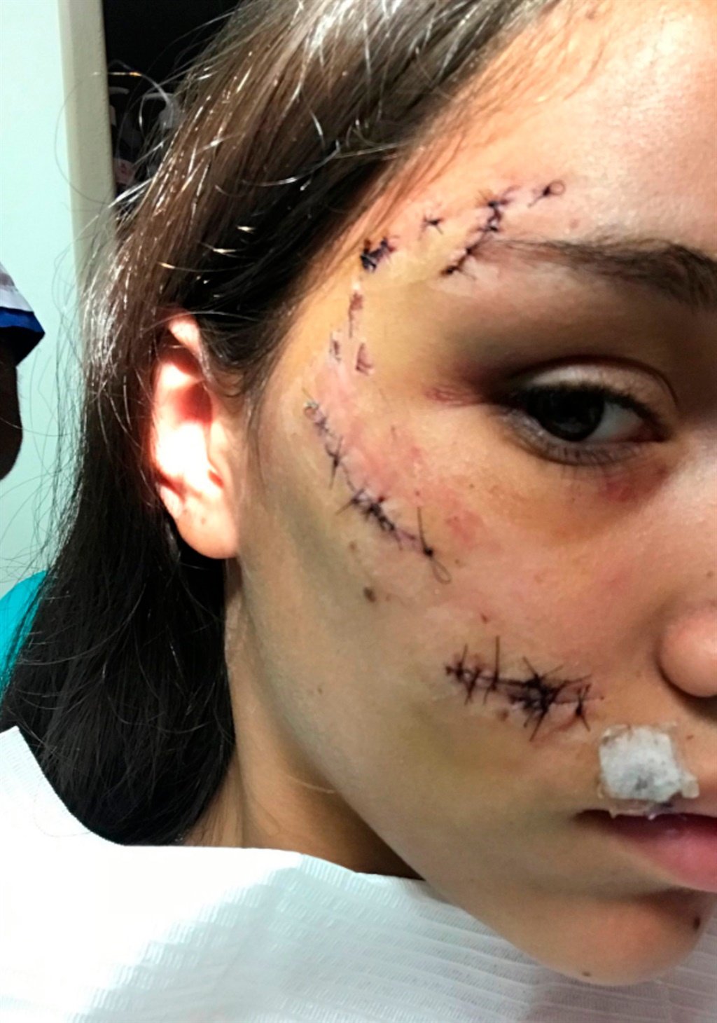 Pic shows: Lara Sanson was injured in the face.