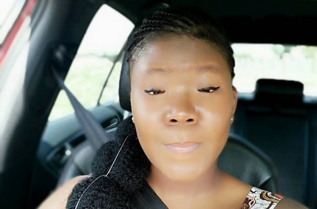 34-year-old Zanele Dlamini from Bushbuckridge was bullied for years because of her droopy eyes, far set eyes and low eyelids. (PHOTO: Supplied)