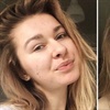 Young woman shares candid selfies of severe acne – and the internet is praising her bravery!