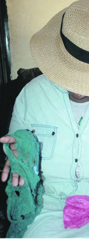 Nokuzola Adonisi claims she has been poked by a tokoloshe with a face of a rat.             Photo by   Nobathembu Zibi 