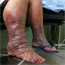 Obesity raises risk for lymphedema