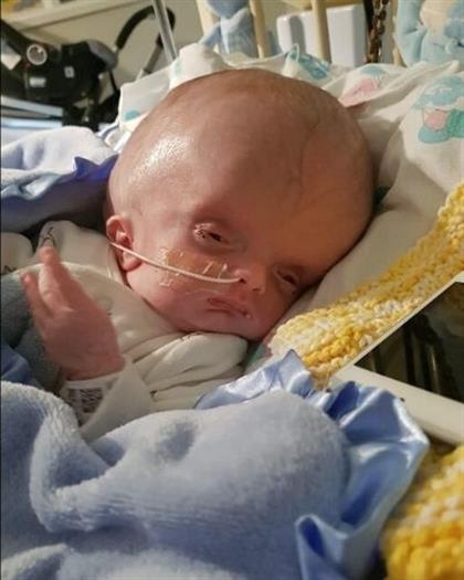 In Pics Miracle Baby Born With Crushed Skull Defies Doctors Odds To Survive Parent